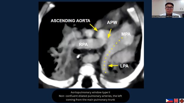 3rd Place: Berry Syndrome: A case report